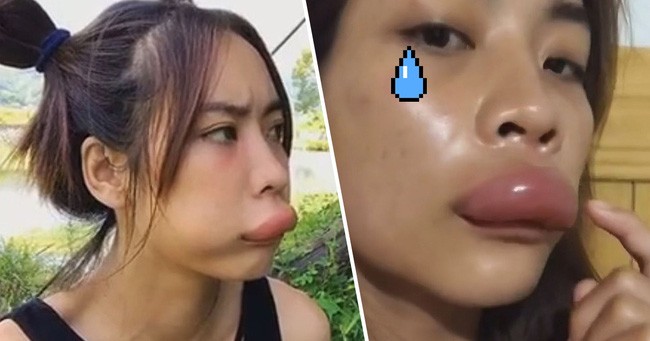 Mơ thấy cô em xấu xí bị ong đốt